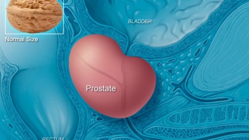 Creando conciencia del cáncer  de próstata  