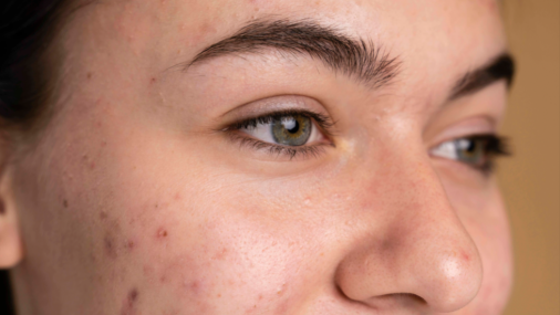 ¿Cómo cerrar los poros y eliminar las  manchas de la piel?