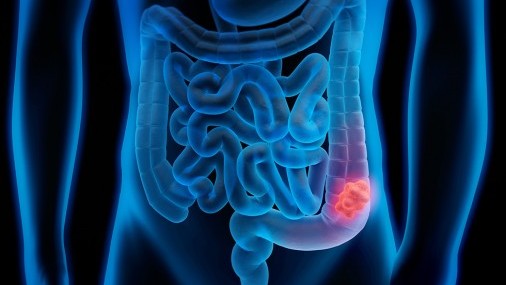 Aumenta el cáncer colorrectal en menores de 50 años en EE. UU.